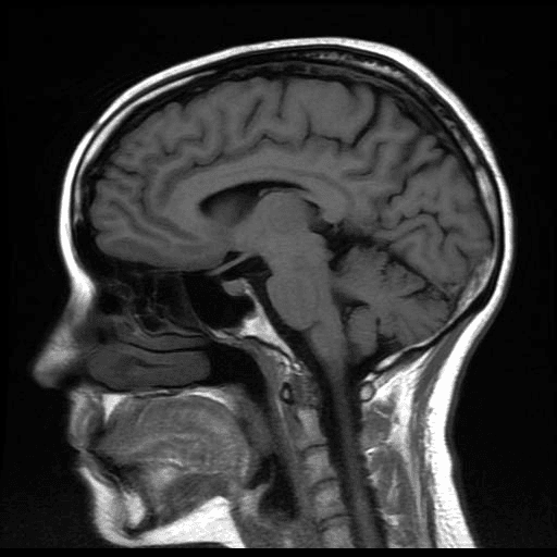 Imagen médica de cráneo, corte sagital